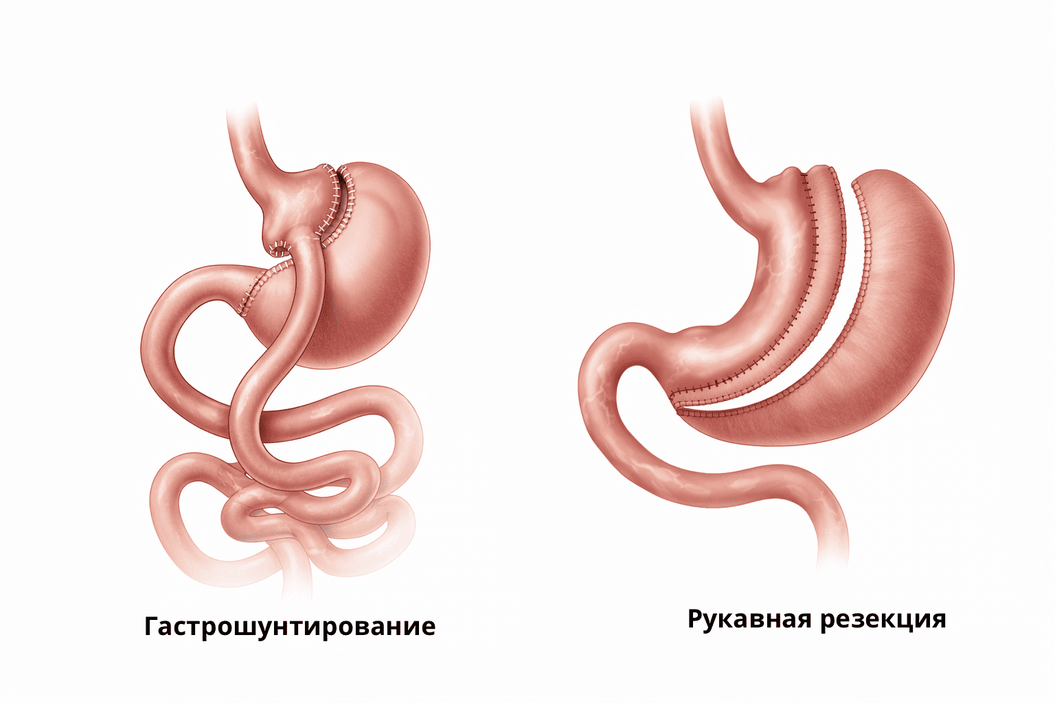 gastroshuntirovanie
